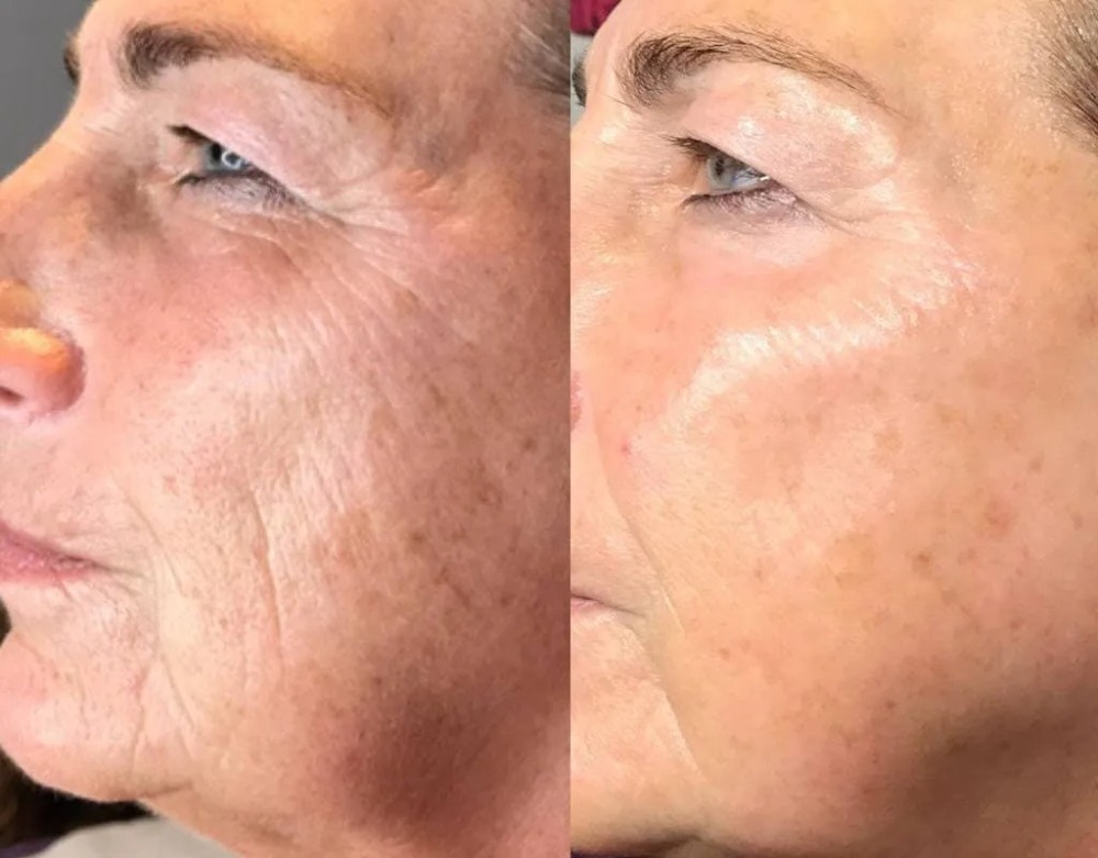 Antes e depois de Marcia, 48 anos